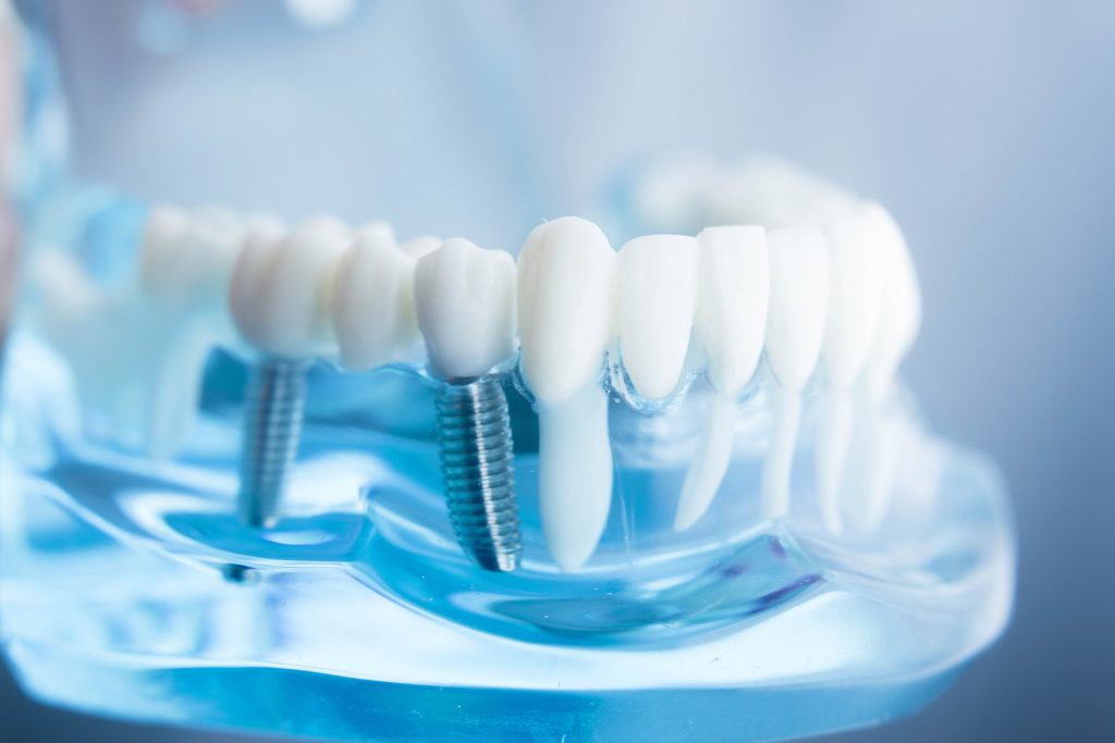 ATAŞEHİR Implant Fiyatları